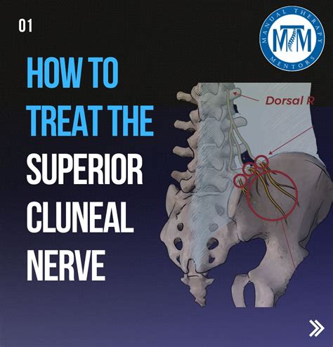 Want to know how to treat superior cluneal nerve entrapment? | Marco ...