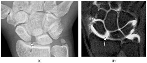 Imaging Diagnosis and Management of Carpal Trauma and Instability—An ...