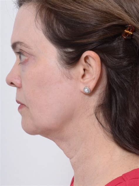 Image result for Profound Face Procedure