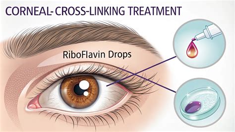 Corneal Cross-Linking Treatment | Eye Hospital in Lucknow