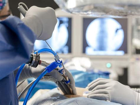 Las claves de la cirugía endoscópica de columna | Meer