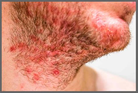 Homeopathic Treatment for Seborrheic Dermatitis, Treatment of ...