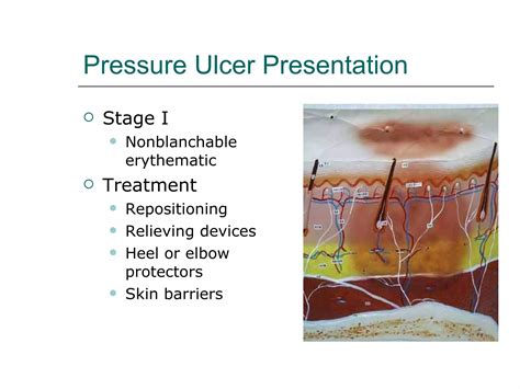 Pressure ulcer presentation3 | PPT