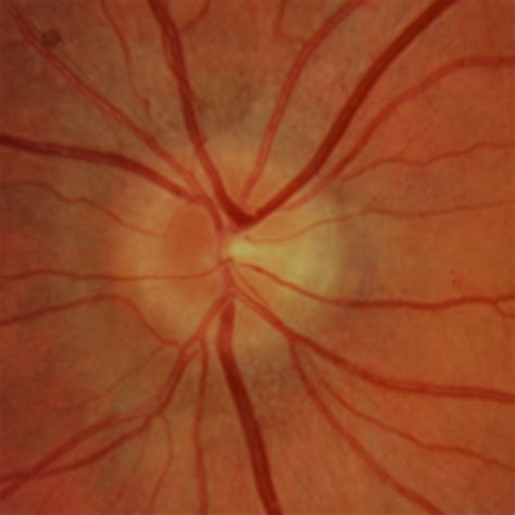 Image result for Sudden Vision Problems