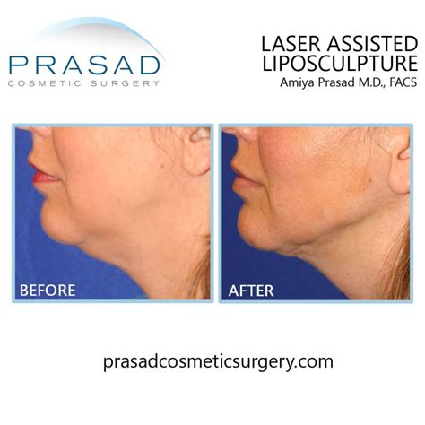 Double Chin Removal: Surgical and Non-Surgical Treatments