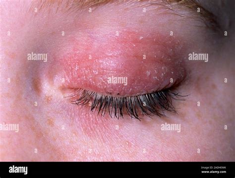 Eczema on eyelid. Close-up of an eczema rash on the eyelid of an 18 ...