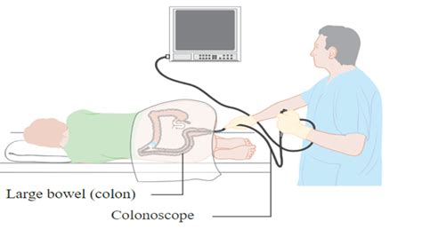 Image result for Position Colonoscopy Procedure