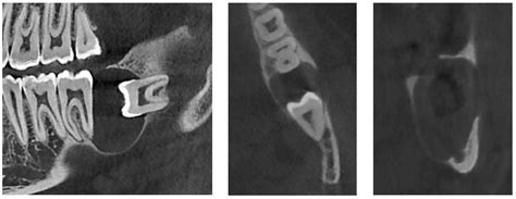 Dentigerous Cysts with Diverse Radiological Presentation Highlighting ...
