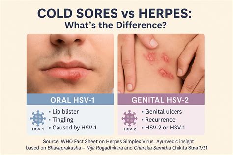 Cold Sores Vs Herpes: Are They The Same?
