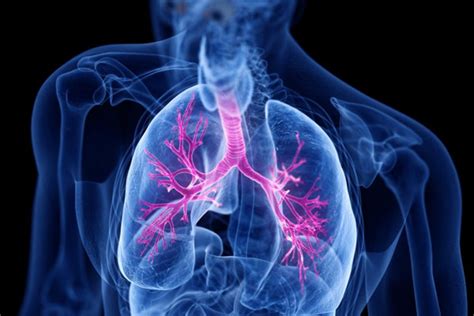 Bronchial Asthma