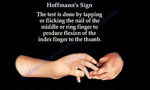 Image result for Hoffman's Sign