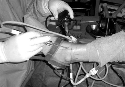 Ankle arthroscopic procedure in the operating room. | Download Scientific Diagram