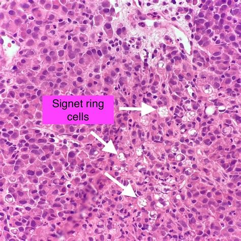 Signet Ring Cell Carcinoma
