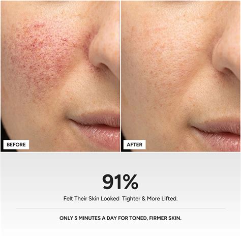 Micro Skin Lift Device – Nyra Tech
