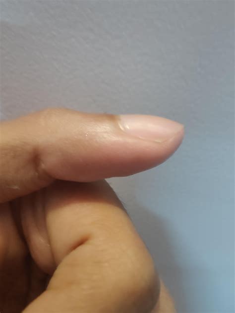 clubbing fingers?. i am 18M. i have noticed my fingers are mildly ...
