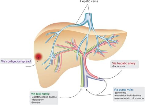 The Evolving Nature of Hepatic Abscess: A Review