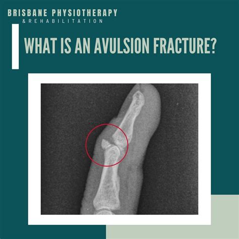 Cast For Avulsion Fracture