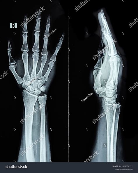 Xray Hand Bones PDF] Detecting Hand Bone Fractures In X Ray Images