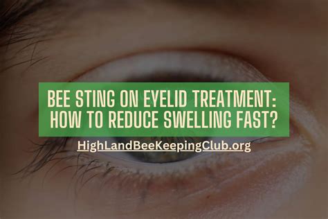Bee Sting on Eyelid Treatment: How To Reduce Swelling Fast?