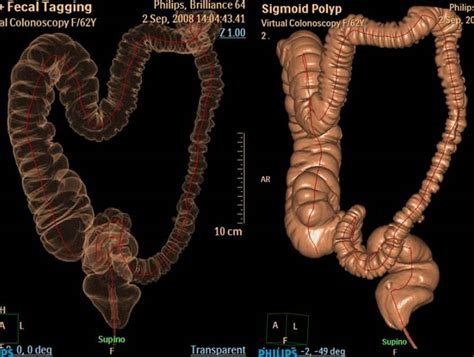 Image result for Endoscopia Virtual Colon