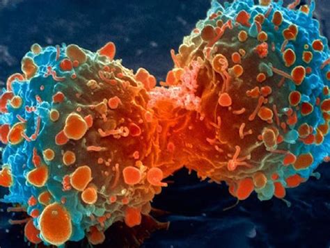 Prostate Cancer: প্রস্টেট ক্যানসারের লক্ষণ 'এটি'ও! শরীরে সামান্য ...