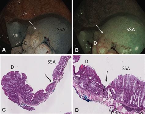 Caught in the act: endoscopic characterization of sessile serrated adenomas with dysplasia ...
