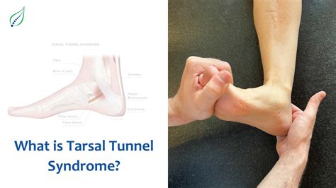Best Doctor in Pune for Cervicogenic Headache (CGH) | Best Back Pain, Slip Disc, Knee Arthritis ... - tarsal tunnel syndrome remedies