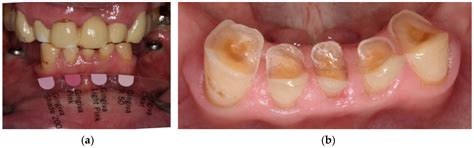 Polyoxymethylene as Material for Removable Partial Dentures—A ...