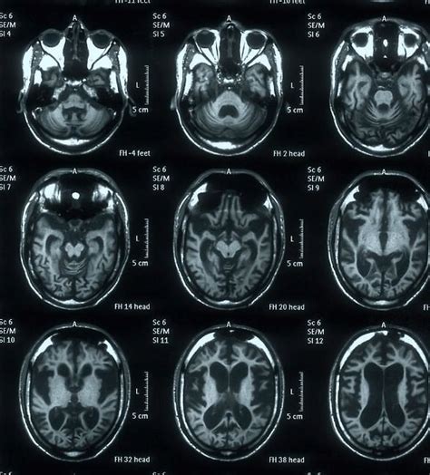 Image result for Diffuse Atrophy