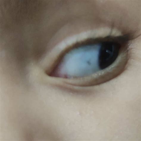 Hello, I have observed a black spot in white area of one eye of my 2 year old daughter. Can ...