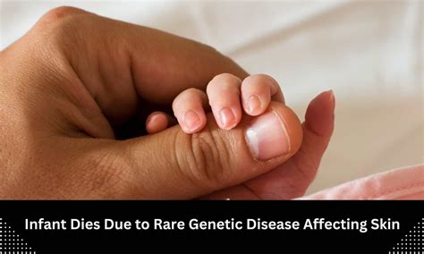 Death of infant due to rare genetic disease affecting skin