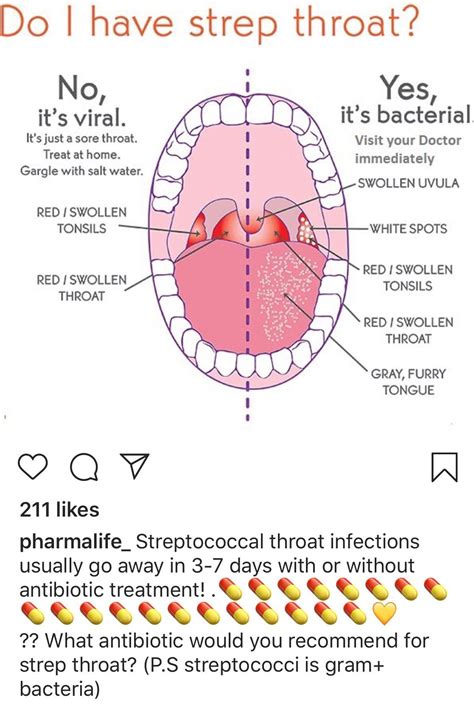 Swollen Uvula, Strep Throat Remedies, Swollen Tonsils, Throat Infection ...