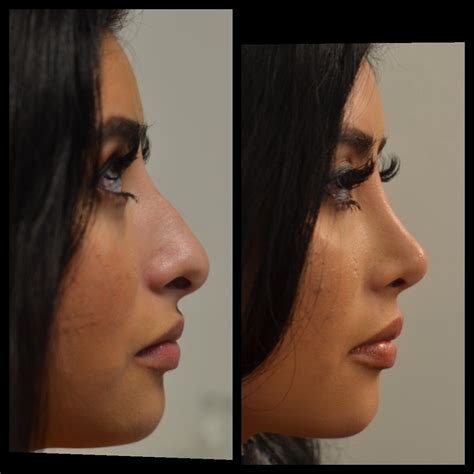 Best Nose Job For Round Face at Noble Paige blog