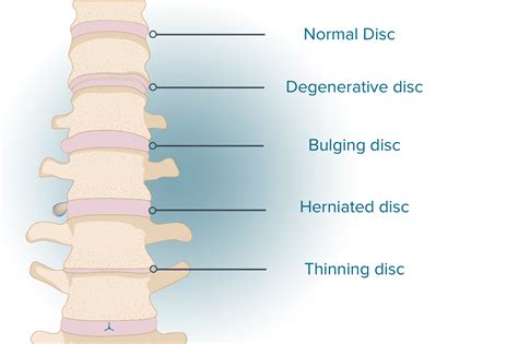 Broad Based Disc Bulge