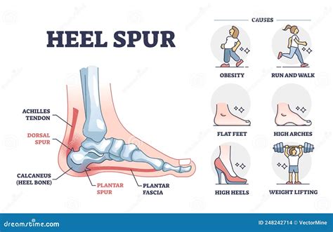 Dorsal Spur Calcaneal Spur. Human Foot Bones. Illustration Isolated On ...