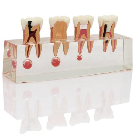 Buy Dentalmall Dental 4-Stage Endodontic Model for Study Teach Teeth ...