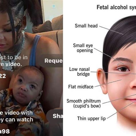 DOES CHRISEAN ROCK BABY HAvE FETAL ALCOHOL SYNDROME? | Listen Notes