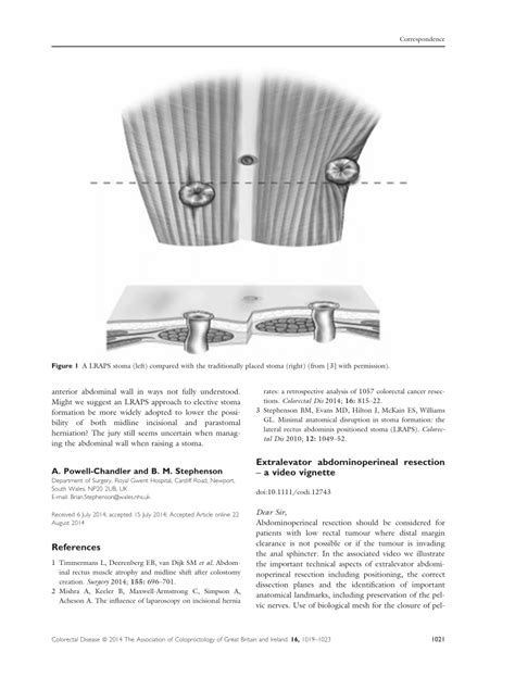 Image result for Levator Resection Surgery