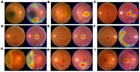Development of a Fundus Image-Based Deep Learning Diagnostic Tool for ...