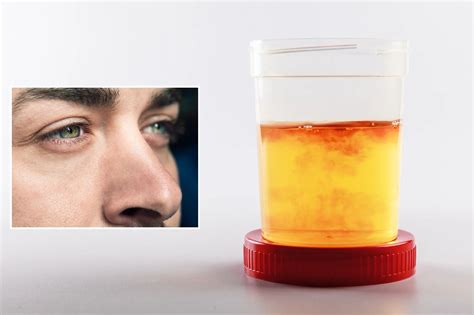 The real horrors of the 'scromiting' weed disorder plaguing ERs