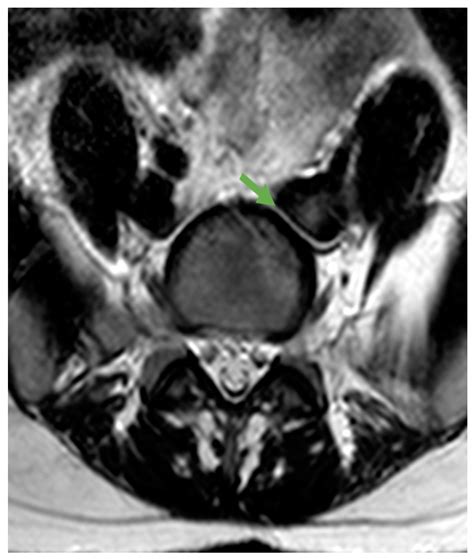 Intraoperative Complications of the Anterior Retroperitoneal Approach ...