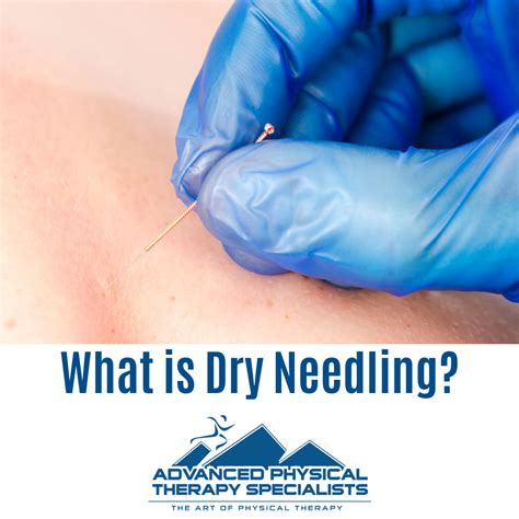 What is Dry Needling? - Advanced Physical Therapy Specialists