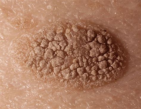 Quick Facts:Seborrheic Keratoses - Merck Manual Consumer Version