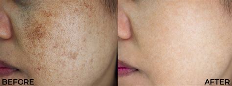Best Pigmentation Treatment in Bangalore, Hyderabad, Chennai