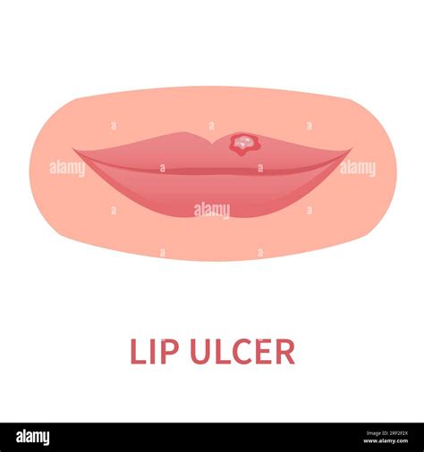 Lips Dry Ulcers at Sara Sheridan blog