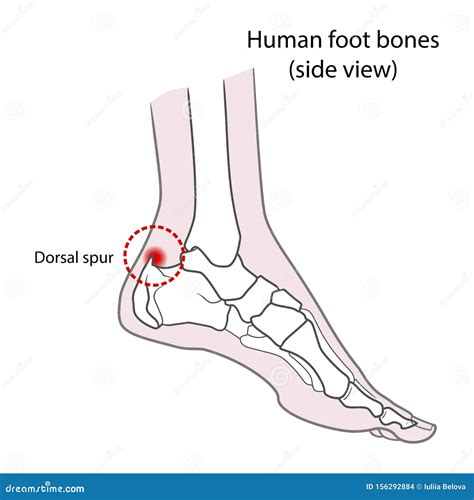 Dorsal Spur Calcaneal Spur. Human Foot Bones. Illustration Isolated On A White Background ...