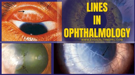Lines in Ophthalmology - Eye Health Nepal