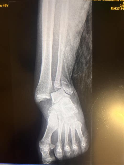 Healing time for severely fractured ankle : r/Adulting