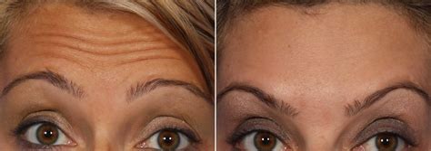 Ботокс (Botox®): сколько единиц нужно, последствия, фото до и после