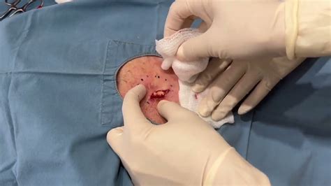 Epic Exploding Cysts 的图像结果